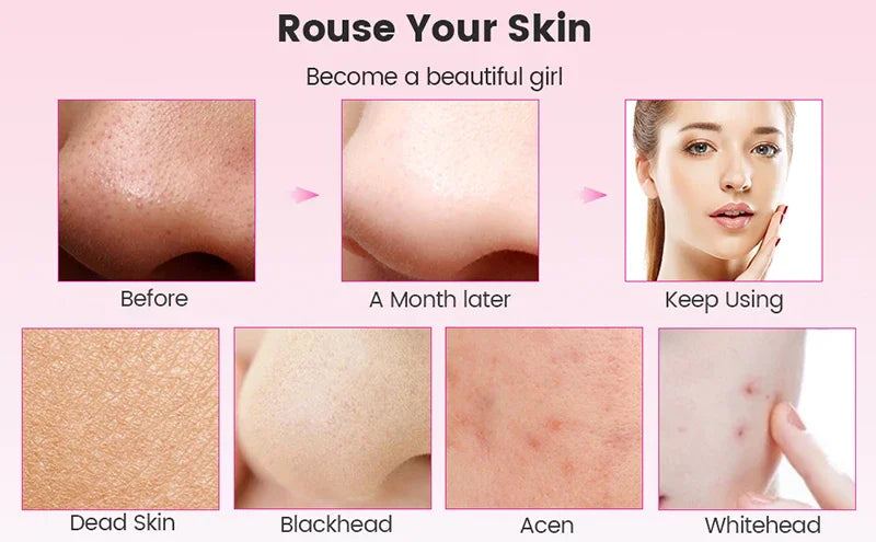 Ultrasonic Skin Care Spatula Vibration Blackhead Remover Cavitation Shovel Facial Exfoliation Skin Care Tools