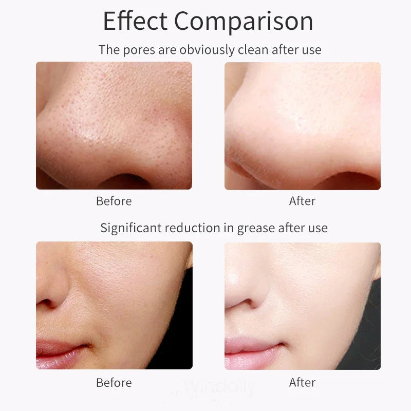 Ultrasonic Skin Care Spatula Vibration Blackhead Remover Cavitation Shovel Facial Exfoliation Skin Care Tools